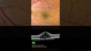 Cystoid macular edema [upl. by Swagerty636]