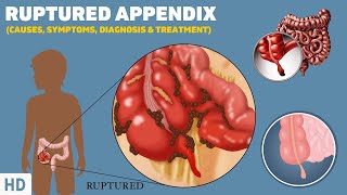 Ruptured Appendix What It Feels Like and How to Recognize the Symptoms [upl. by Yretsym]