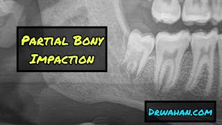 Black  White Version Mesioangular Impaction Removed with a Buccal Trough [upl. by Alwitt]