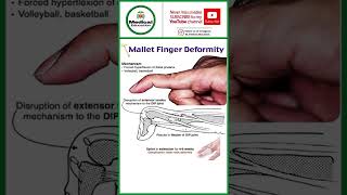 Mallet finger ddeformity [upl. by Ritch825]