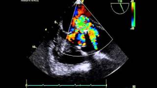 AORTIC DISSECTION ECHOCARDIOGRAPHY [upl. by Akenehs]