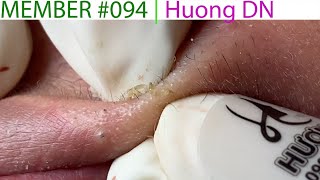 Acne Treatment Huong Da Nang 094  Member  Huong [upl. by Acimaj]