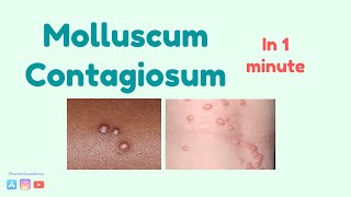 Molluscum Contagiosum Causes symptoms and treatment [upl. by Rehtse]