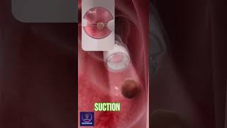 Removing Large Polyps shortmedical [upl. by Nekial124]