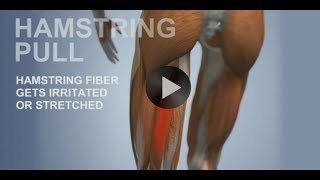 Common Sports Injuries Hamstring Pull [upl. by Treblihp274]