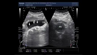 Ultrasound Video showing Gall Bladder stones and sludge differentiation [upl. by Aronoh]