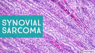 Synovial Sarcoma 101…Explained by a Soft Tissue Pathologist [upl. by Leizar]