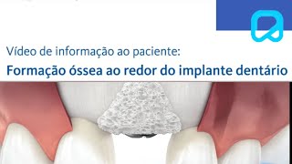 Formação óssea ao redor do implante dentário dralexguedes [upl. by Nam332]