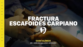 Fractura de escafoides [upl. by Pylle]