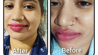 Mole Removal treatment in Balasore II 9692414824 [upl. by Ahtekal]