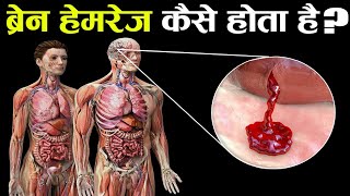 ब्रेन हेमरेज कैसे होता है और क्या होता है What Happens in Brain Hemorrhage [upl. by Waldner617]