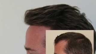 Hair Transplant Turkey Dense Packing Hairline Hairline Clinic [upl. by Line]