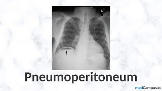 Pneumoperitoneum Chest XRay Signs  High Yield  Radiology [upl. by Anawak]