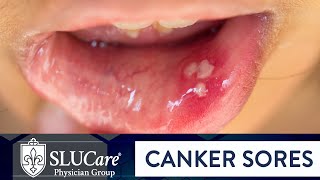 Determining Causes amp Treatment for Canker Sores  SLUCare Otolaryngology [upl. by Eedna]