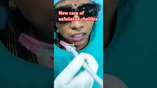 New case of exfoliatve cheilitis treated by Laser [upl. by Elleon582]