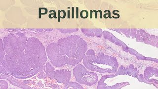 What are Papillomas  Pathology mini tutorial [upl. by Orose]