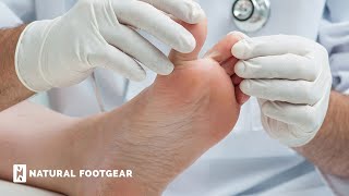 How Can I Treat Numbness in My Second Toe  Natural Footgear [upl. by Simonette]