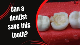 Can this tooth be saved Post amp core and Tooth preparation [upl. by Atinus]