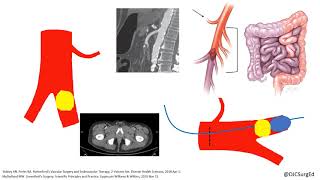 Acute Limb Ischemia [upl. by Swayder721]