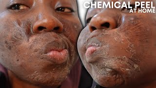 CHEMICAL PEEL FULL PROCESS AT HOME USING JESSNERS PEEL  BEFORE amp AFTER [upl. by Islek109]