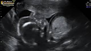 Ecografia HD 2D Diagnóstico prenatal Hidrops Fetal hidropesia Dr Rafael Ortega Muñoz Ginecologo [upl. by Odragde]