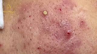 Treatment of pustules and inflammatory acne 84  Loan Nguyen [upl. by Esnahc]