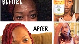 Burts Bees Natural Acne Solutions Review before and after [upl. by Burt]