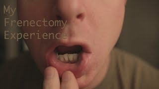 My Frenectomy Experience [upl. by Leesen]