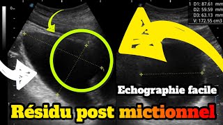 Evaluation du résidu post mictionnel en échographie [upl. by Nowell]