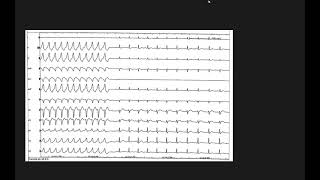 심실성 빈맥의 치료 단형 심실빈맥monomorphic VT 다형 심실빈맥polymorphic VT 응급구조사 전문심장소생술 ACLS [upl. by Ailadgim]