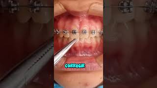 Mejora tus dientes con los fierros dentales dientes dentista tips parati viral fyp [upl. by Harwin]