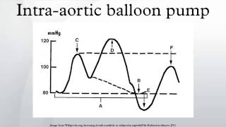 Intraaortic balloon pump [upl. by Andromeda]