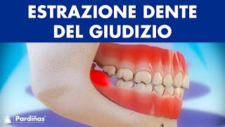 Estrazione dente del giudizio e pericoronarite © [upl. by Daph63]