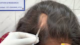 Alopecia areata  Injection technique for Triamcinolone acetonide  10 mgmL Dr Bhawuk Dhir [upl. by Gilbert475]