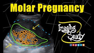 Molar Pregnancy  Hydatidiform Mole  Ultrasound  Case 281 [upl. by Cini]