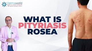 Skin Rash Pityriasis Rosea Hai  Symptoms Aur Treatment Explained  dermaworldskinclinics [upl. by Jessi]