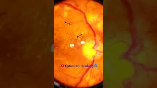 Diabetic retinopathy  Hemorrhages  cotton wool spots  Hard exudates  Fundus  Short Video 134 [upl. by Saideman]