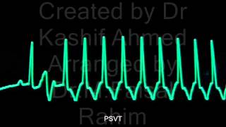 Paroxysmal Supra Ventricular Tachycardia by Dr MFaisal Rahim and Dr Kashif Ahm [upl. by Felicity789]