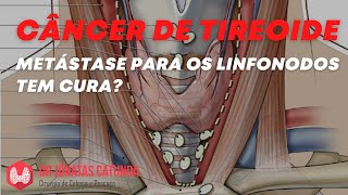 Metástase para o linfonodo tem cura  Câncer de tireoide [upl. by Asereht]