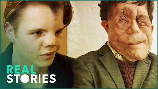 The Ugly Face of Disability Hate Crime Adam Pearson Documentary  Real Stories [upl. by Reimer]