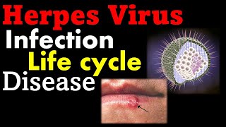 Herpes virus infection and treatment [upl. by Franchot]