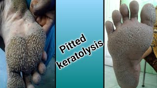 Pitted Keratolysis [upl. by Neirrad]