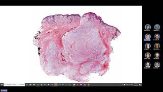 GYN soft tissue tumor pathology [upl. by Cedric]