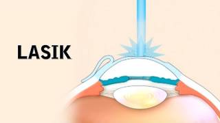 LASIK Surgery and its Risks [upl. by Nasaj]