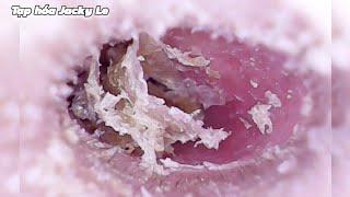 Ear Wax Removal 195 Ears with a lot of dust and very dry wax cause pain  Ear Cleaning ASMR [upl. by Marney]