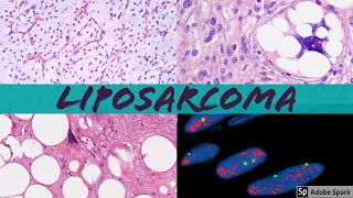 Liposarcoma 101 Everything a Pathologist Needs to Know [upl. by Vernita]