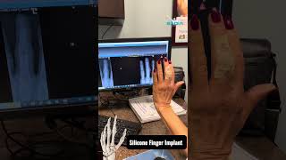 Impressive before and after xrays  🫨 Finger Arthritis PIP Joint [upl. by Ahsekel815]