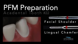 PFM Preparation on Mandibular Canine  Acadental Tooth 22 [upl. by Iridis]