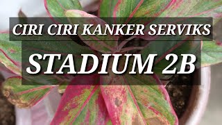 CIRI CIRI KANKER SERVIKS STADIUM 2B [upl. by Vince]