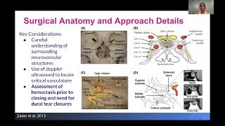 Pituitary Adenomas Diagnosis and Management by Sheena Kalagara [upl. by Maffa]